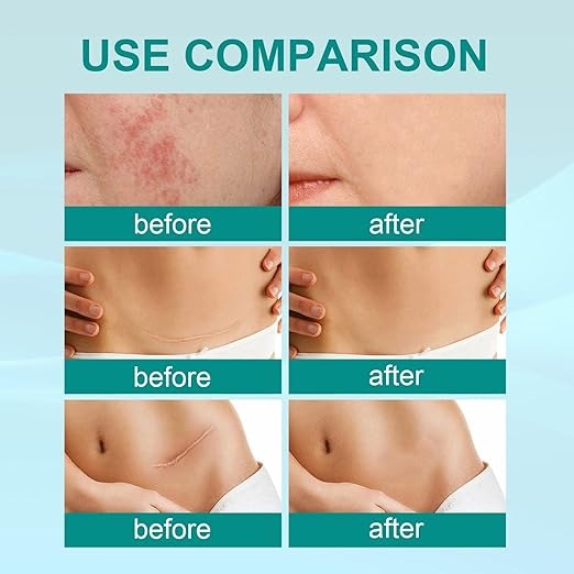 South Moon  Scar Spray