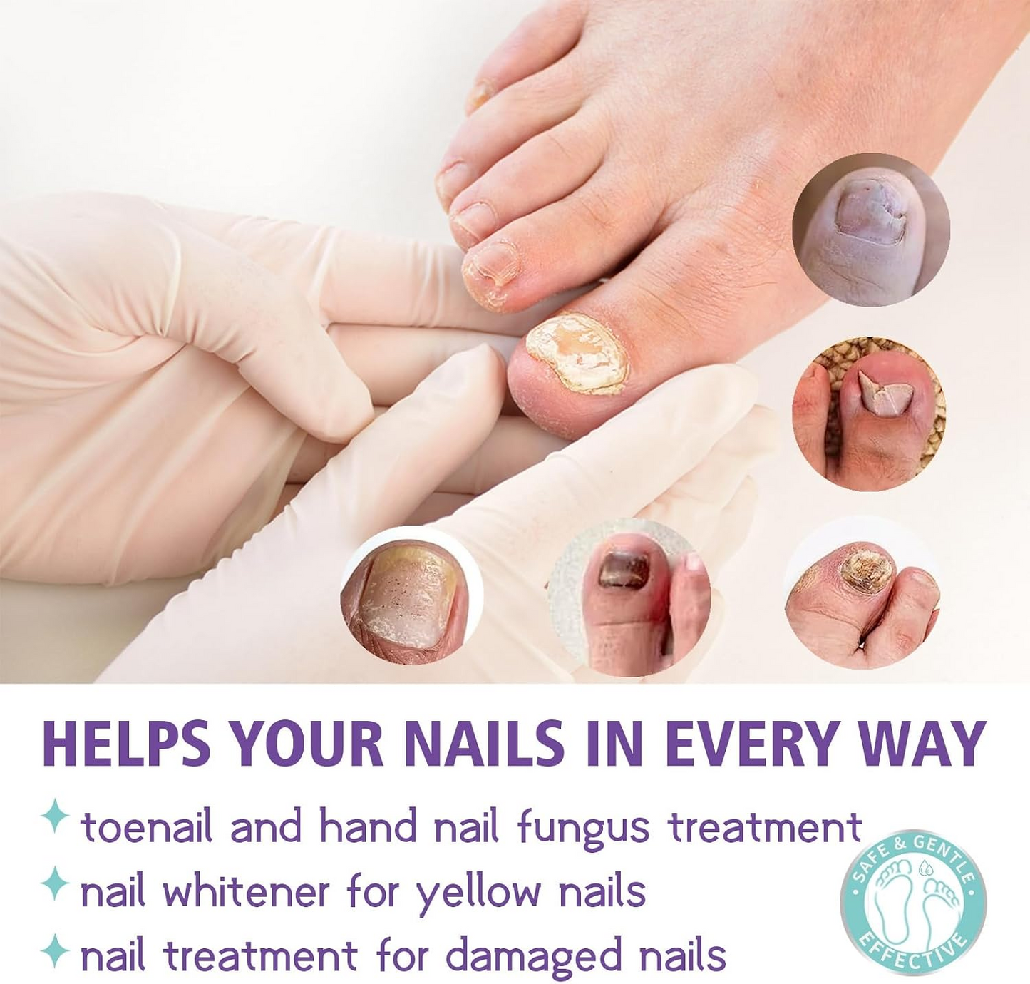 Extra Strong Nail Fungus Treatment Spray - 100ml