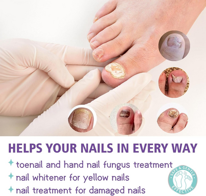 Extra Strong Nail Fungus Treatment Spray - 100ml