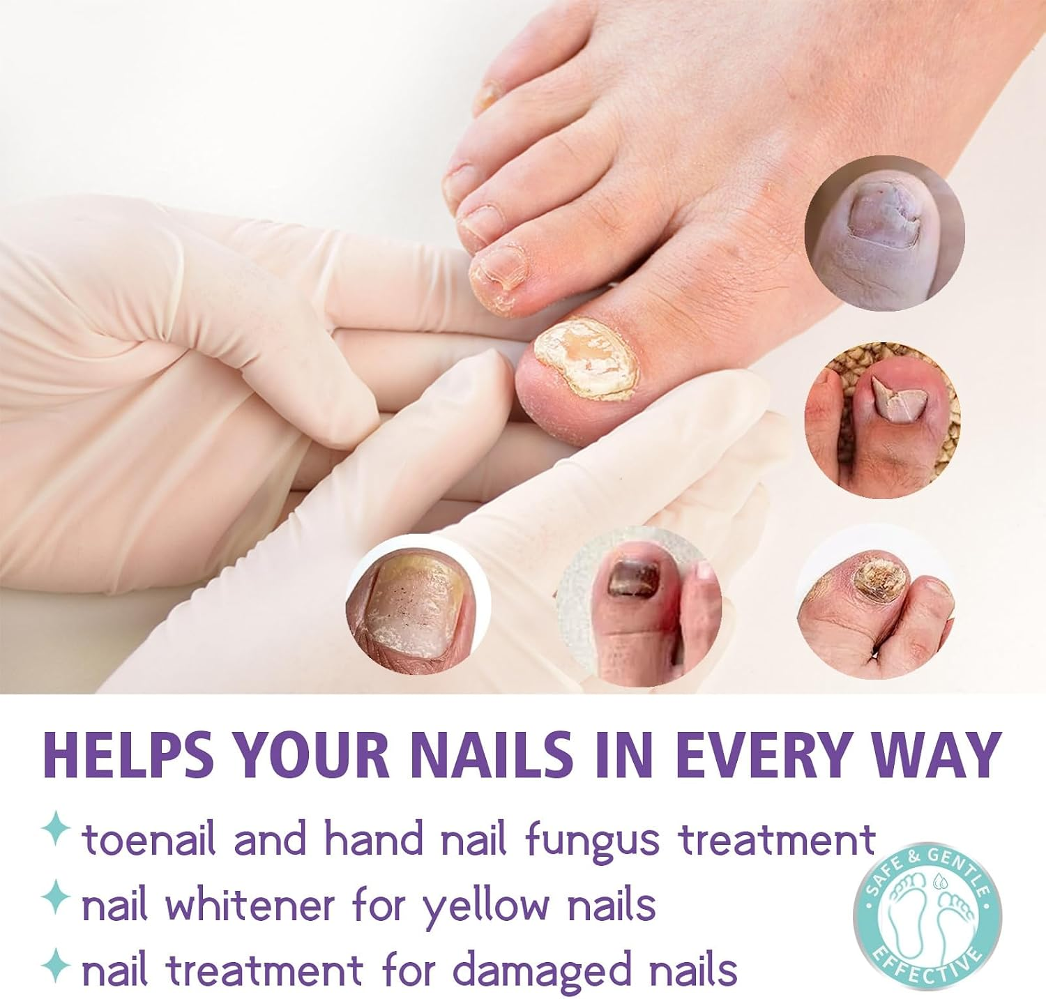 Extra Strong Nail Fungus Treatment Spray - 100ml